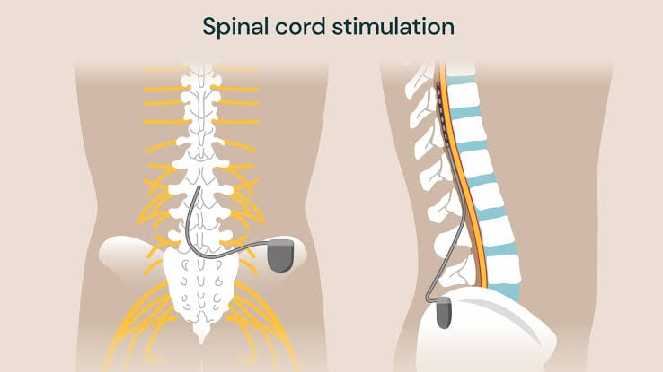 spinal cord stimulation Al Ain
