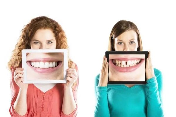 How Do Missing Teeth Affect Your Smile and Confidence?