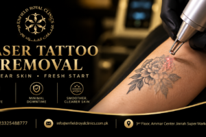 laser tattoo removal