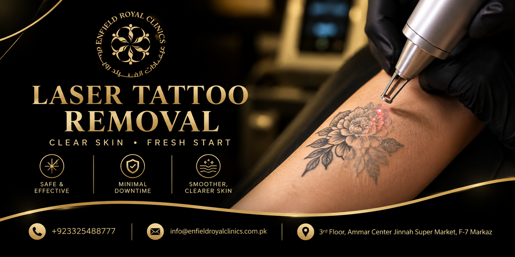 laser tattoo removal
