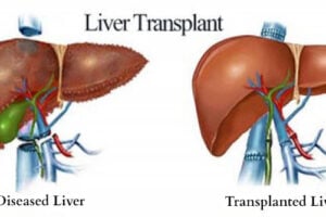 liver transplant specialist in noida