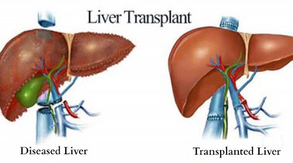 liver transplant specialist in noida