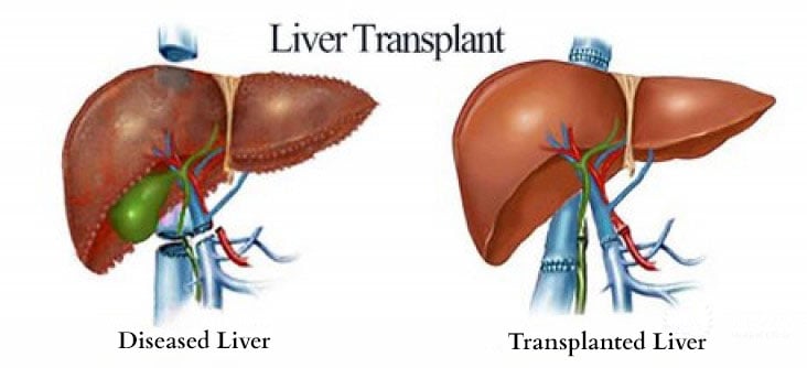 liver transplant specialist in noida