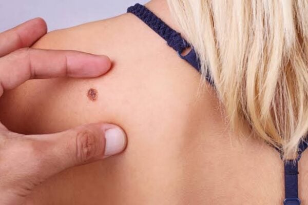 skin cancer