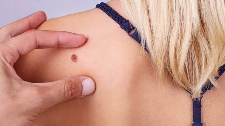 skin cancer